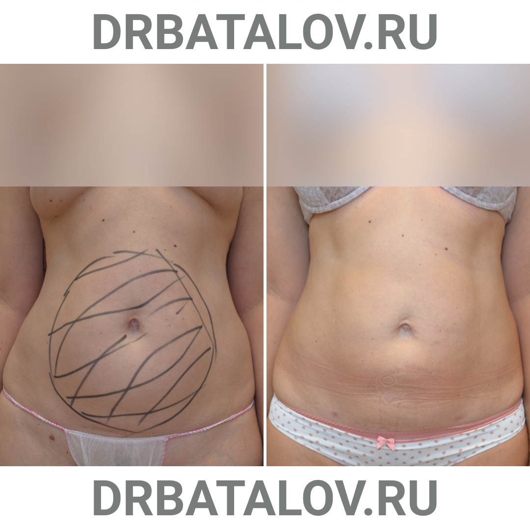 Радиочастотная липосакция Body Tite