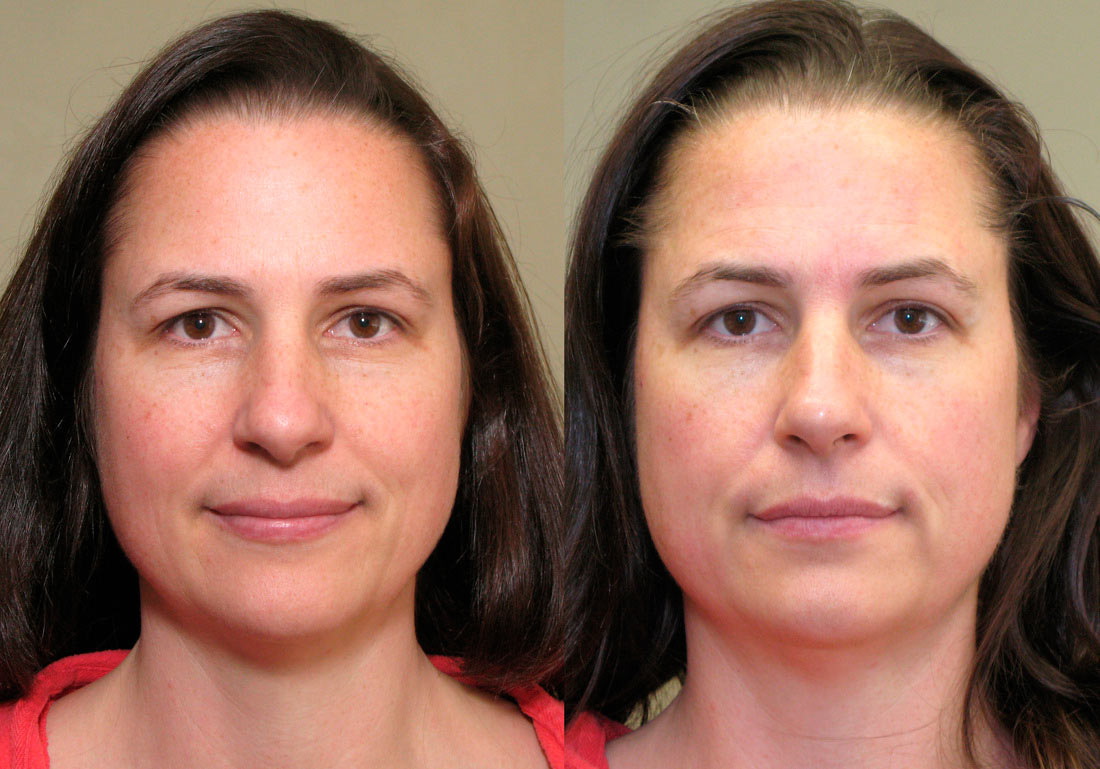Маски для лица до и после. Микротоковая терапия для лица до и после. Микротоки для лица результат. Микротоковая терапия для лица Результаты. Микротоки для лица до и после.