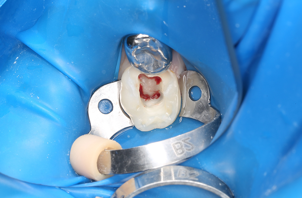 Восстановление зуба коронкой после лечения пульпита