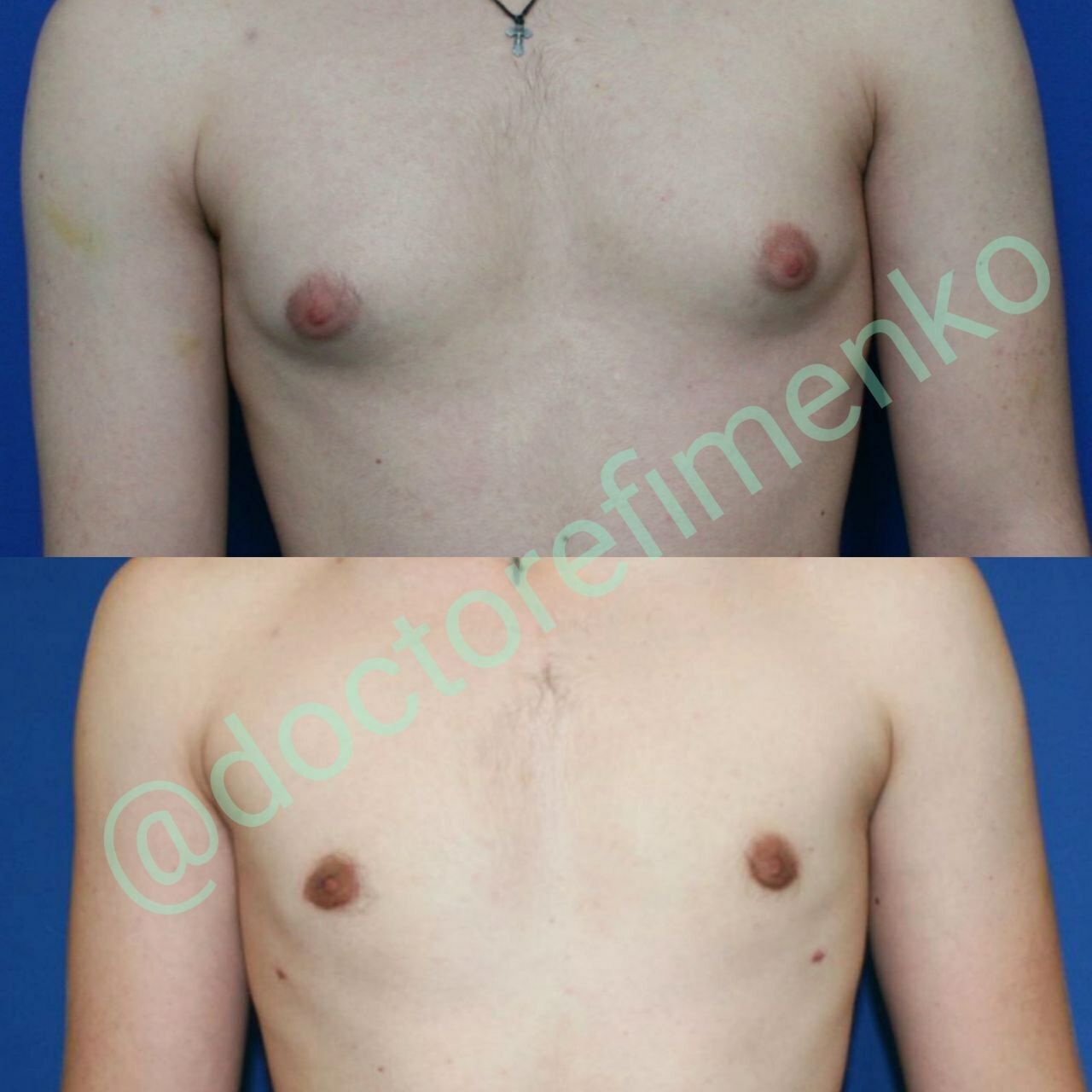 пластический хирург москва маммопластика. клиника пластики в москве подтяжка груди. пластический хирург москва маммопластика. пластика груди. пластическая операция на грудь.
