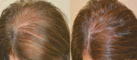 Фото 3. Плазмотерапия головы Regenlab до и после