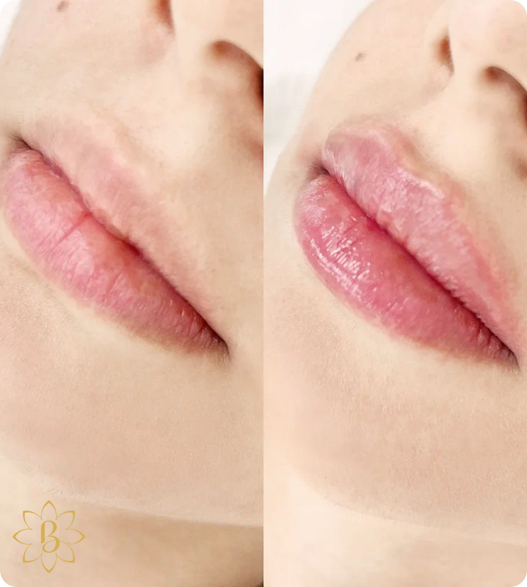 Александритовая лазерная эпиляция