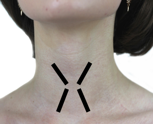 Щитовидная железа пропедевтика. Область проекции щитовидной железы. Проекция щитовидки на шее. Лимфоузлы на щитовидке