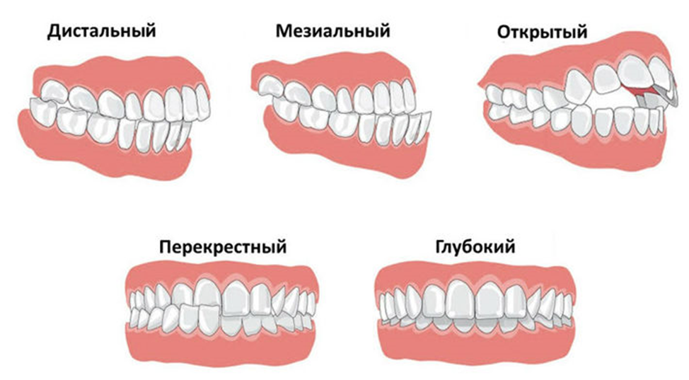 Осмотр стоматолога. Профгигиена полости рта. Зубы без проблем. Зубы без проблем. Ортодонт каппы элайнеры.