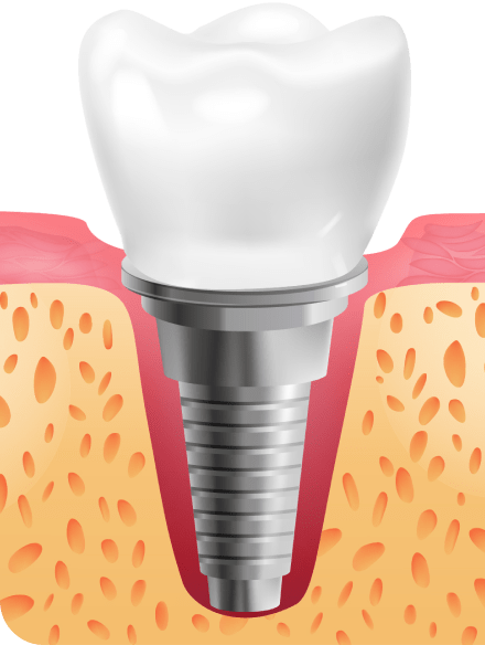 Установка коронки