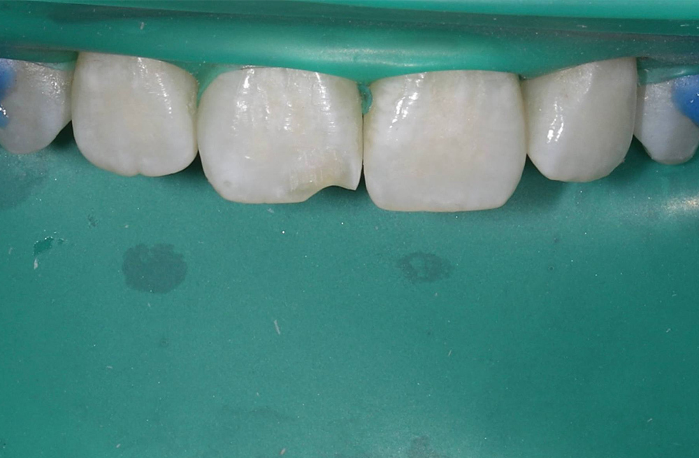 Восстановление отколотого переднего зуба у подростка за один визит