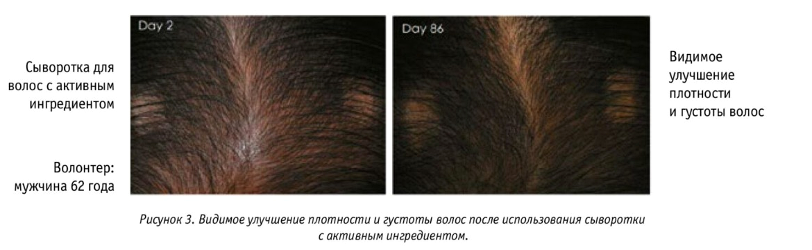 Сравнение плотности и густоты волос на второй и восемьдесят шестой день