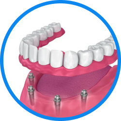 Установка имплантов в Дербенте. Имплантация при отсутствии одного зуба.