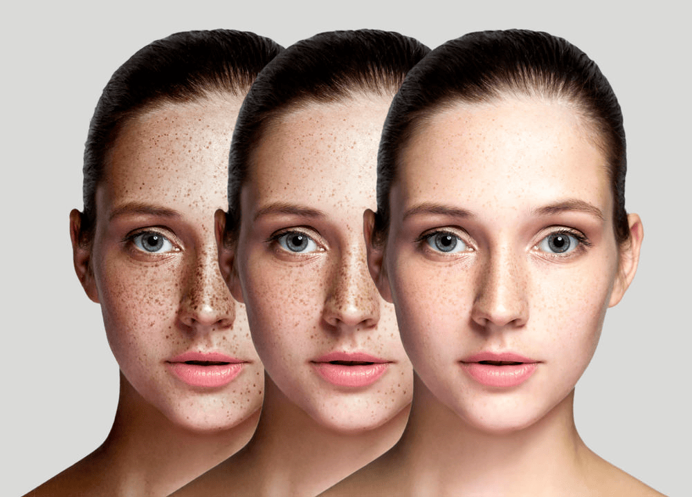Как убрать пигментные пятна на лице: причины возникновения и методы лечения пигментных пятен