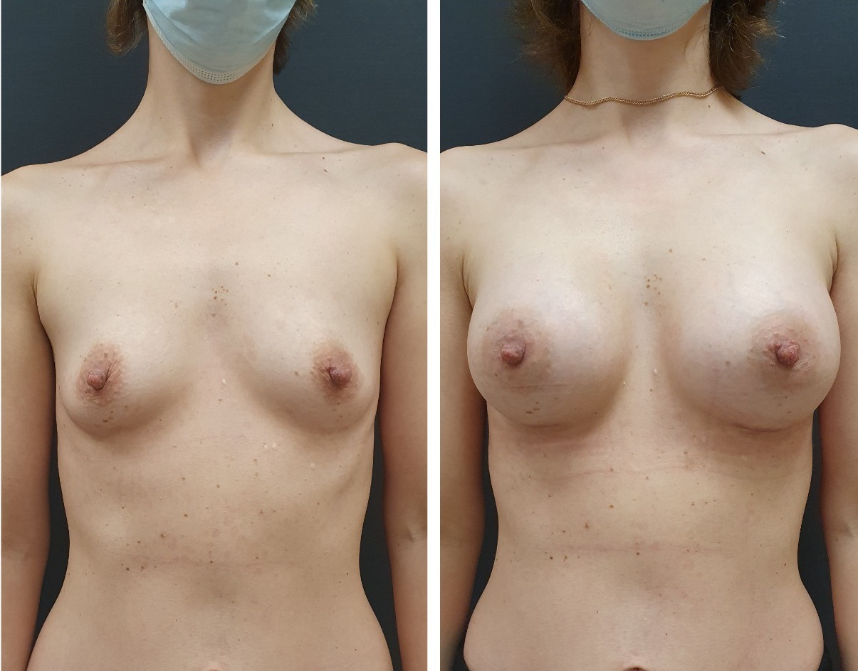 как увеличить одну грудь без операции фото 76