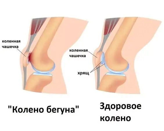 Артроз коленных суставов или гонартроз