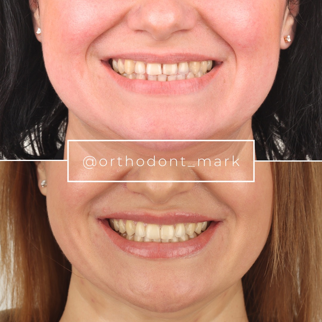 Class III Correction With Diastema Closure and Mini-Implant Anchorage