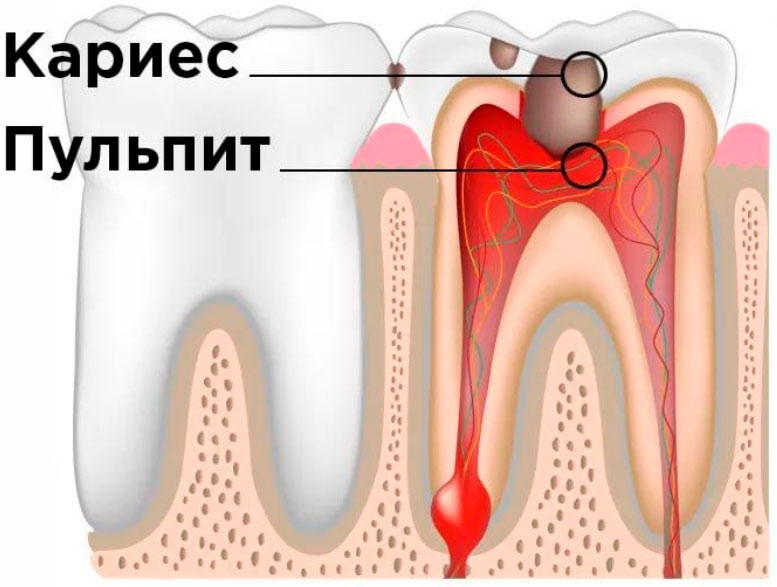 Почему зубы реагируют на холодное и горячее?