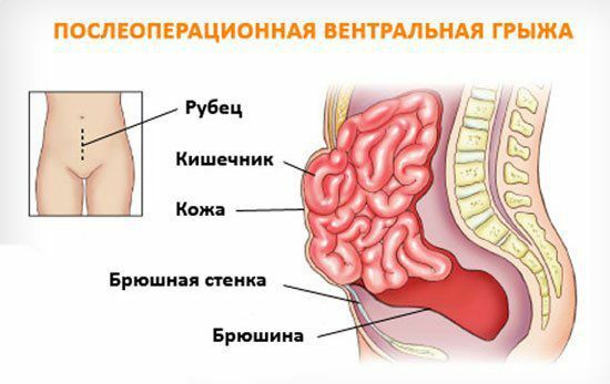 Послеоперационная вентральная грыжа - классификация, лечение