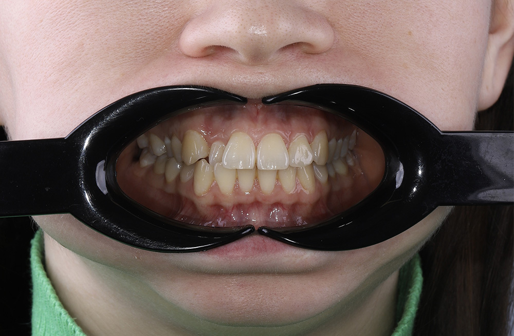 Комплексная ортодонтическая коррекция сочетанной аномалии прикуса с ботулинотерапией и использованием опорных минивинтов