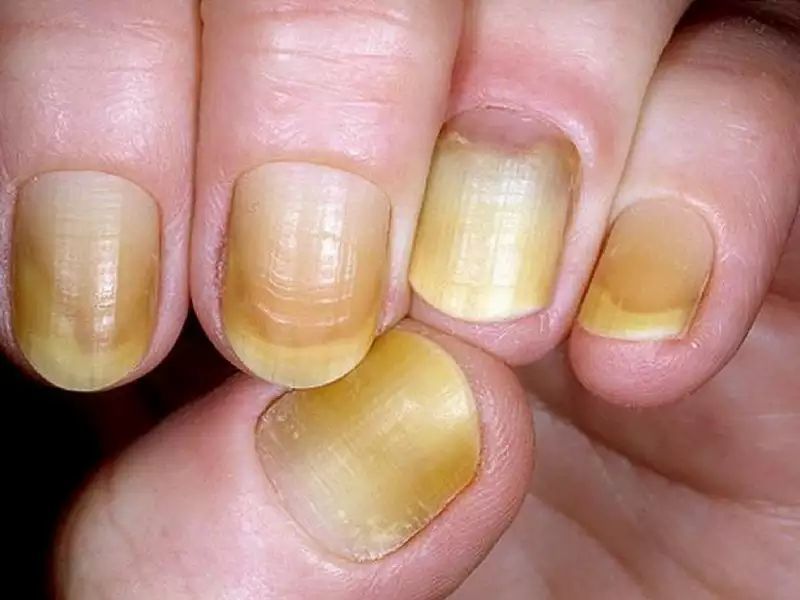 Грибковые болезни ногтей