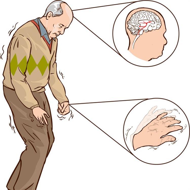 Болезнь Паркинсона: симптомы и признаки у женщин и мужчин. Уход за ...