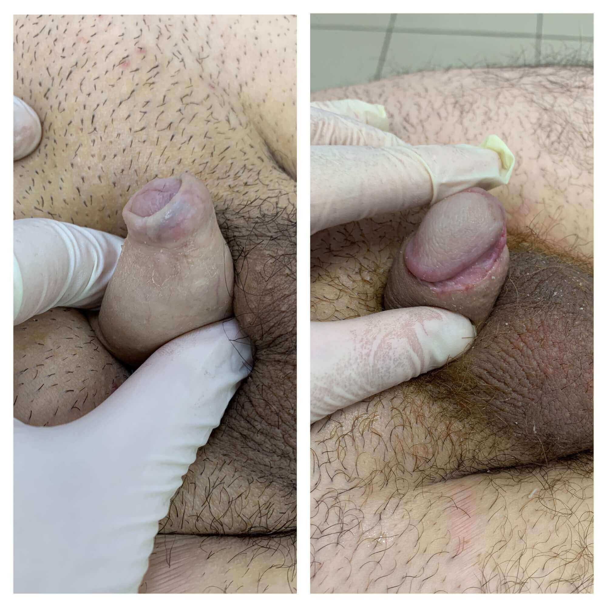 Svampeinfektion penis.