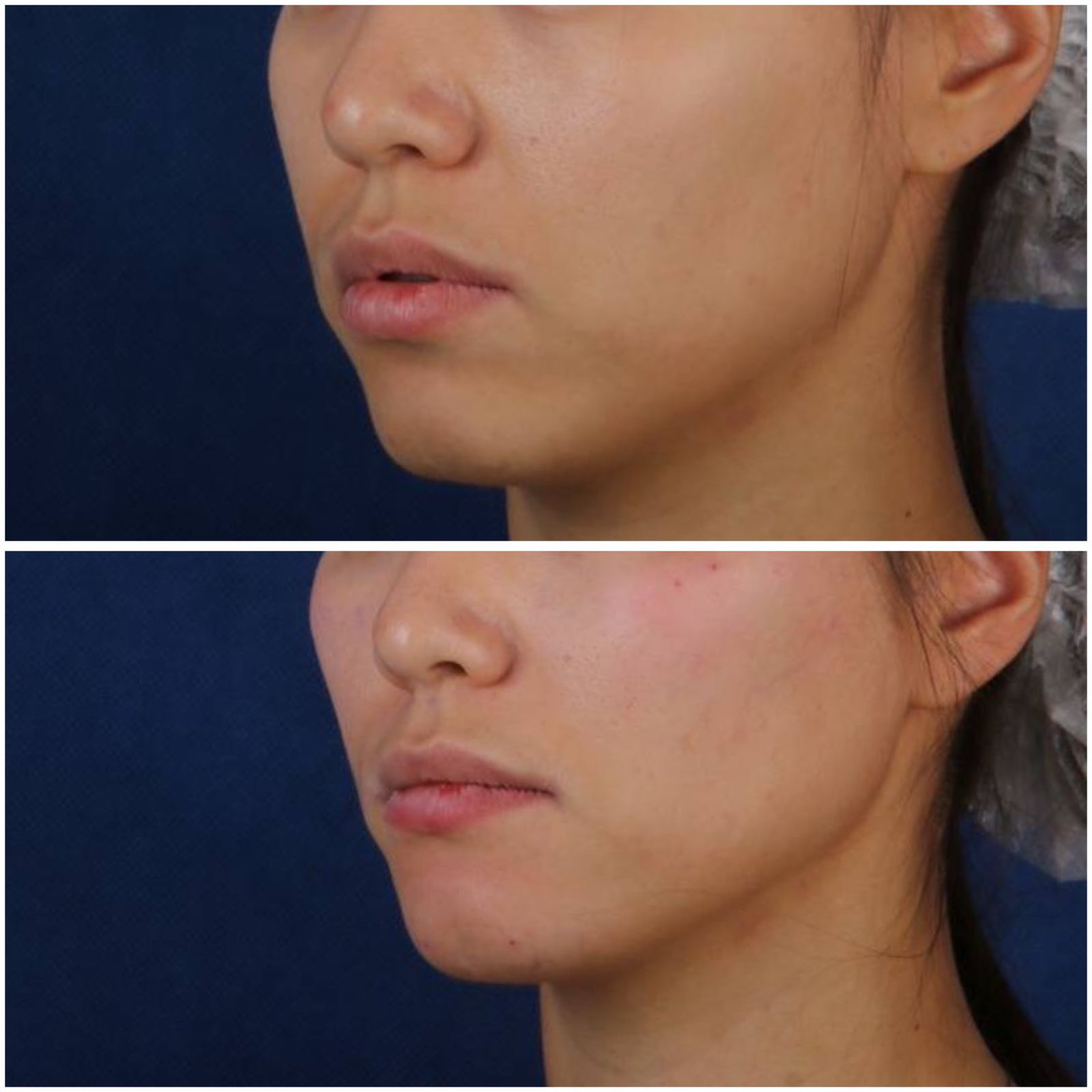 Фото до и после: V-lifting в клинике PradusCOSMO, Санкт-Петербург. Безоперационное омоложение и восстановление овала лица