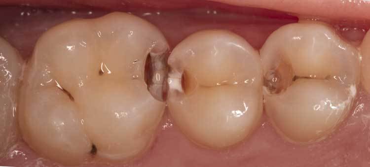 Временная пломба на зуб
