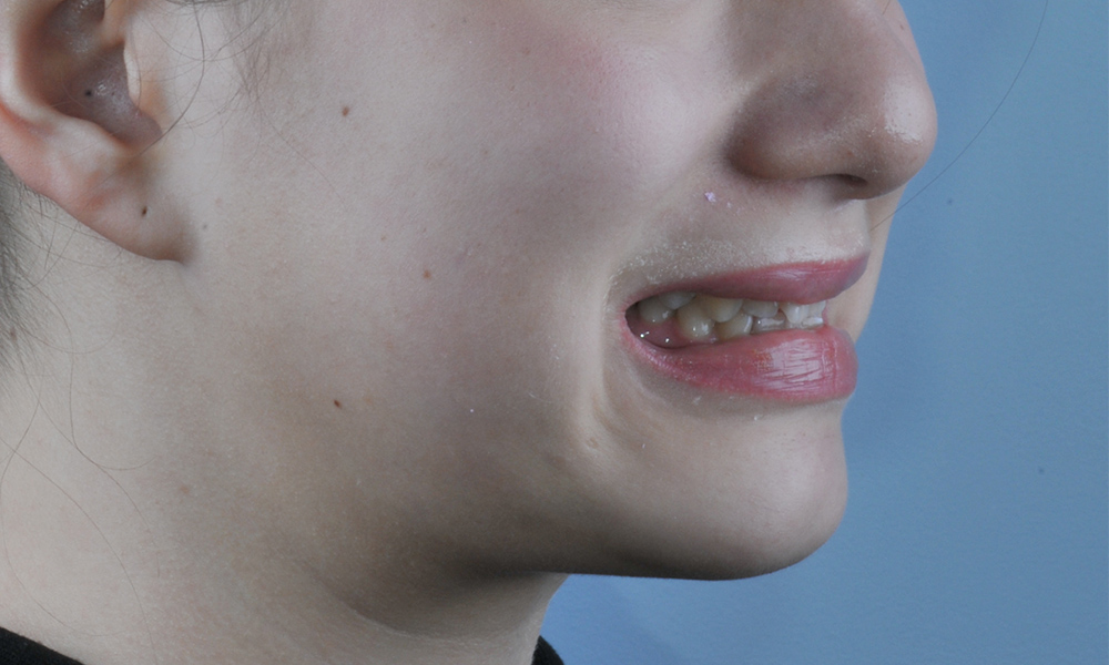 Коррекция зубочелюстных аномалий брекетами у подростка