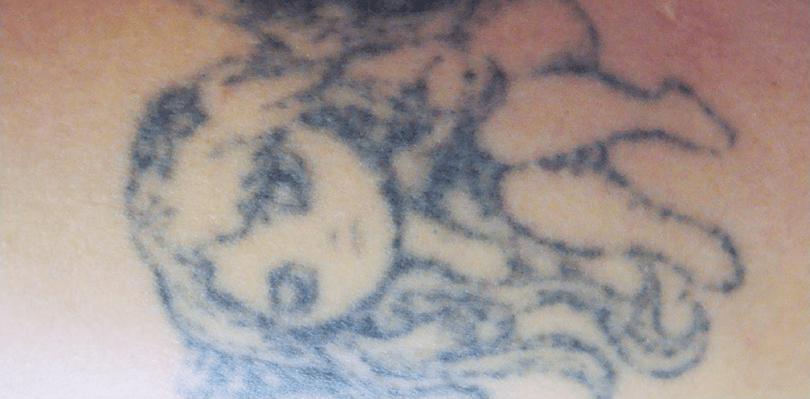 Свести татуировку лазером в Мурманске