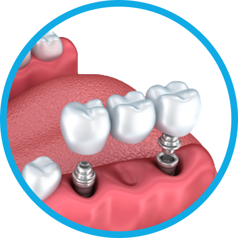 Установка имплантов в Дербенте. Имплантация при отсутствии одного зуба.