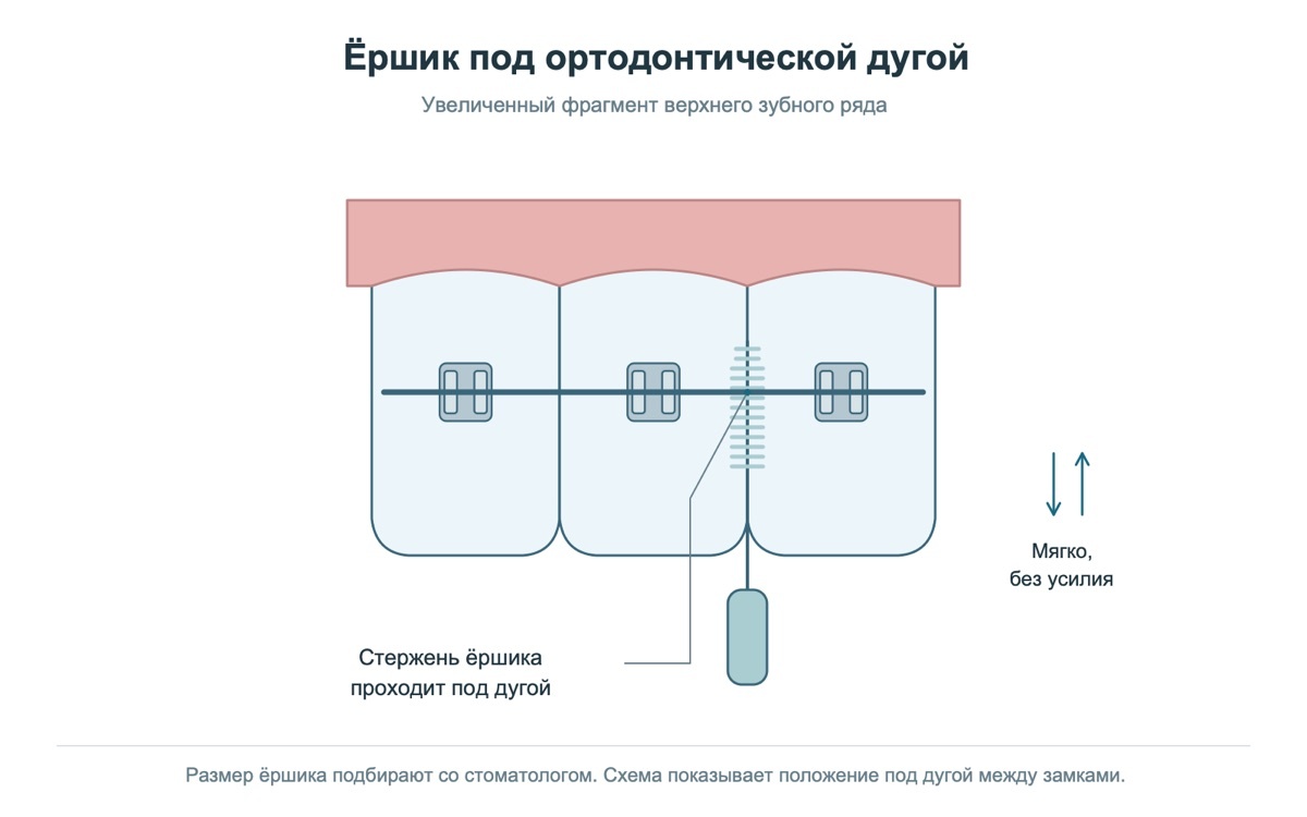 Межзубный ёршик помогает очистить участки вокруг элементов брекет-системы