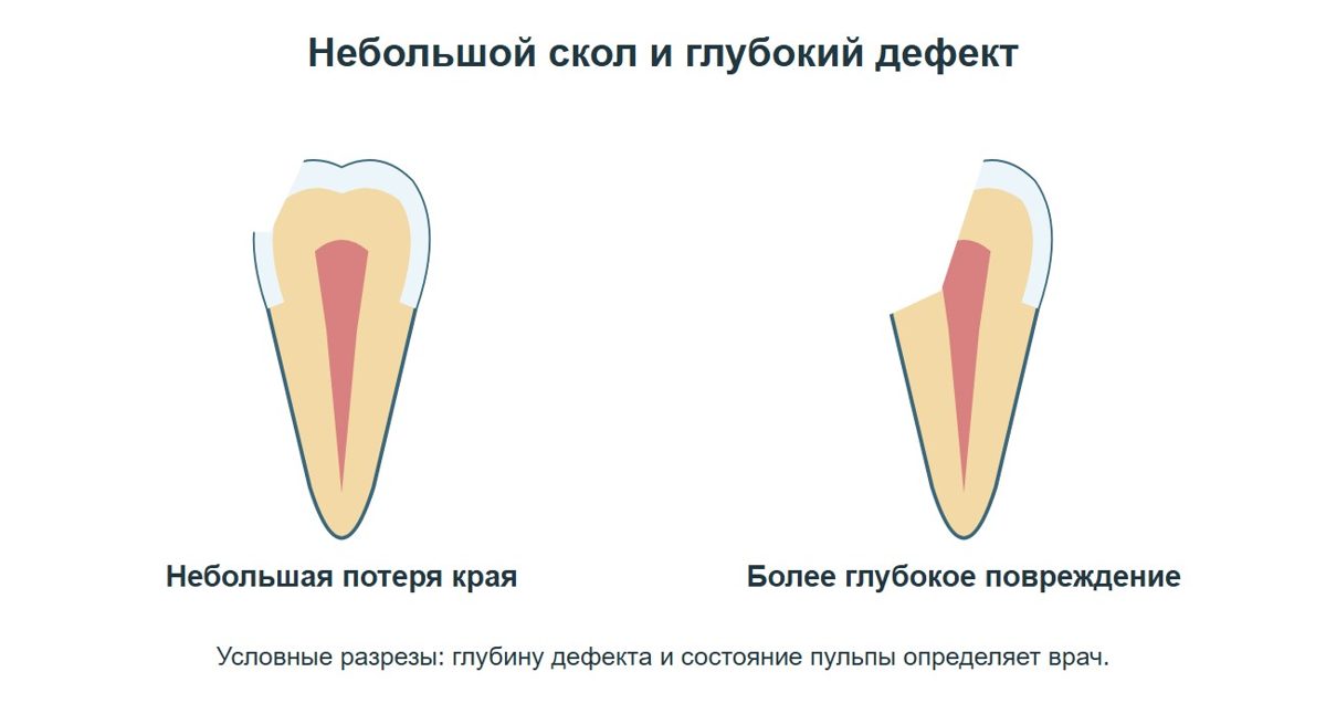 Разная глубина скола зуба