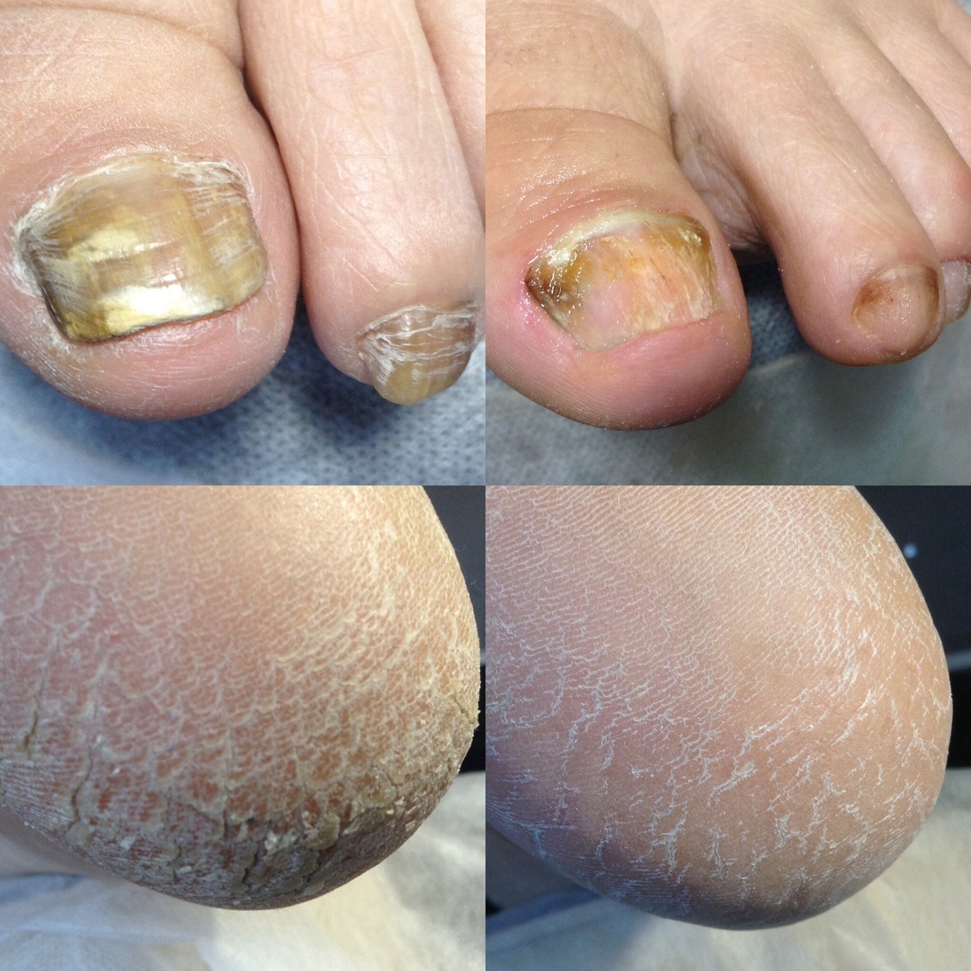 Удаление грибка на ногах в Курске