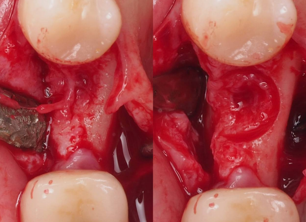 Выравнивающая фреза от Mega'Gen