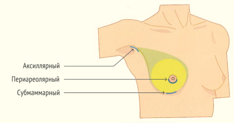 Мастопексия - хирургическая подтяжка кожи груди