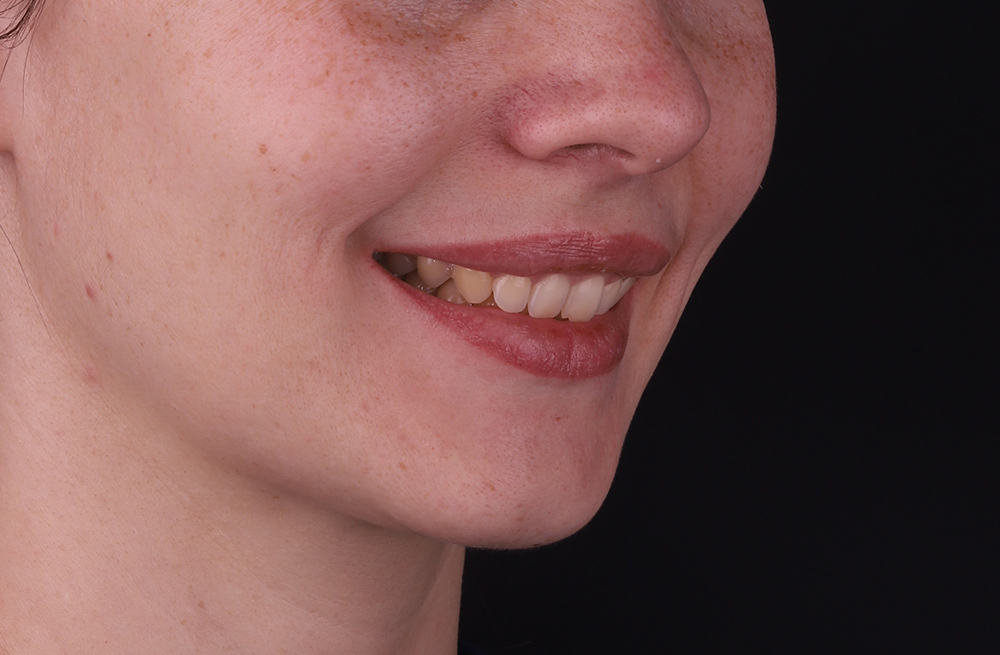 Клинический случай коррекции глубокого прикуса с ретрузией фронтальных зубов на системе прозрачных капп