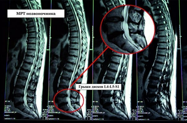 Межпозвоночная грыжа фото как выглядит