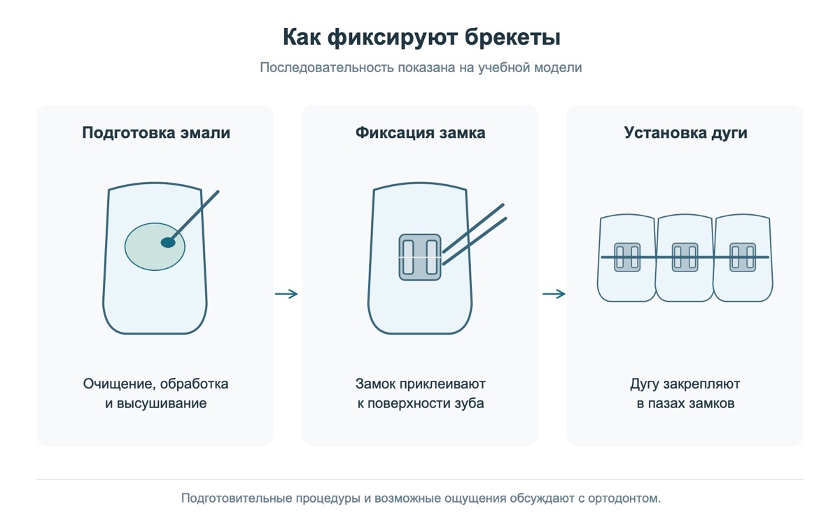 Фиксация брекетов на учебной модели