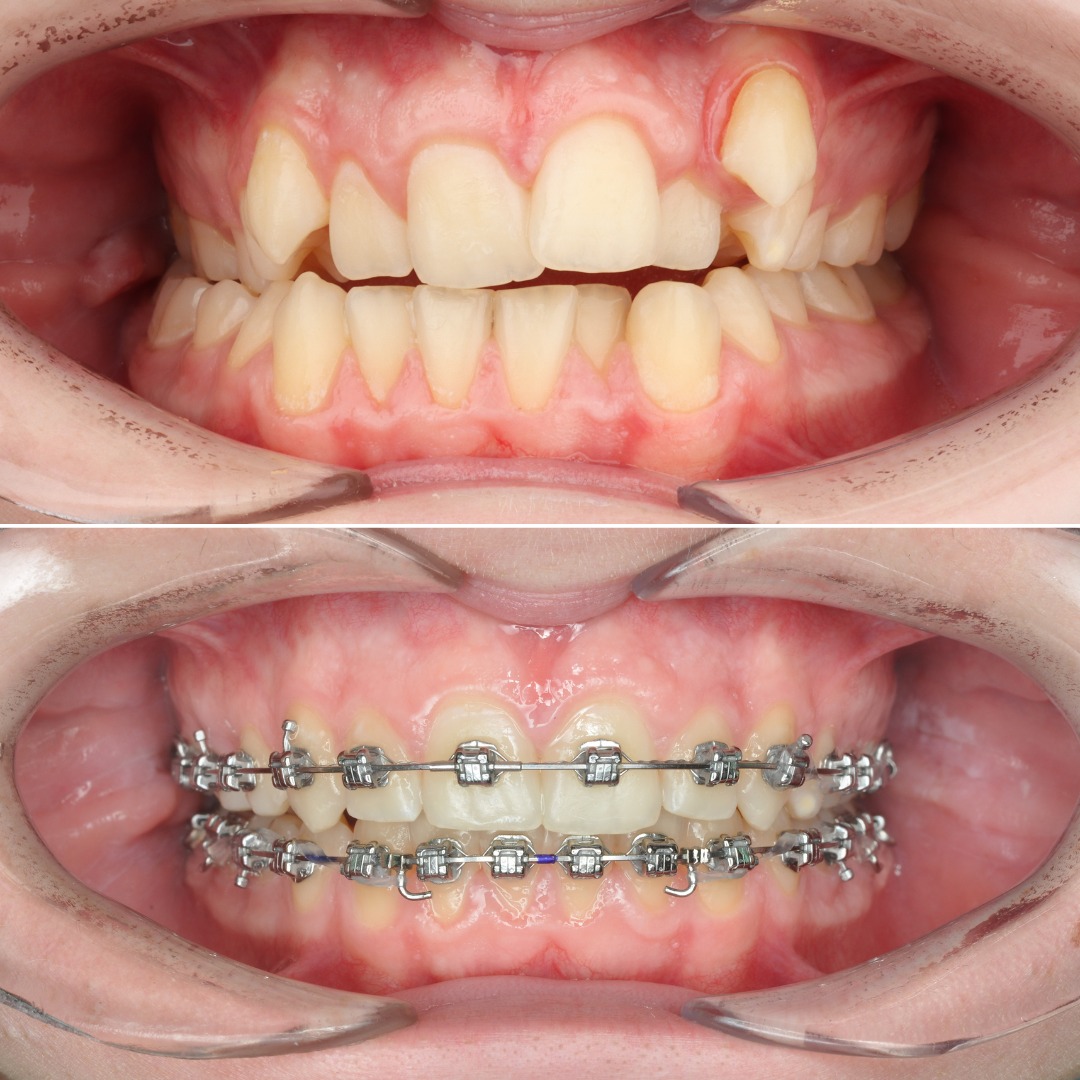 Stage view of MARPE appliance placement supporting skeletal expansion and molar distalization — photo 2 of 5