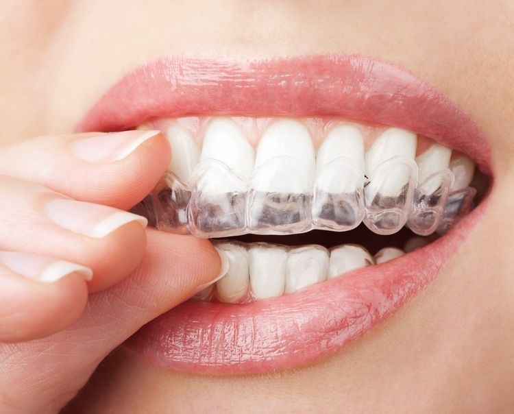 ТОП 8 способов отбеливания зубов с использованием соды