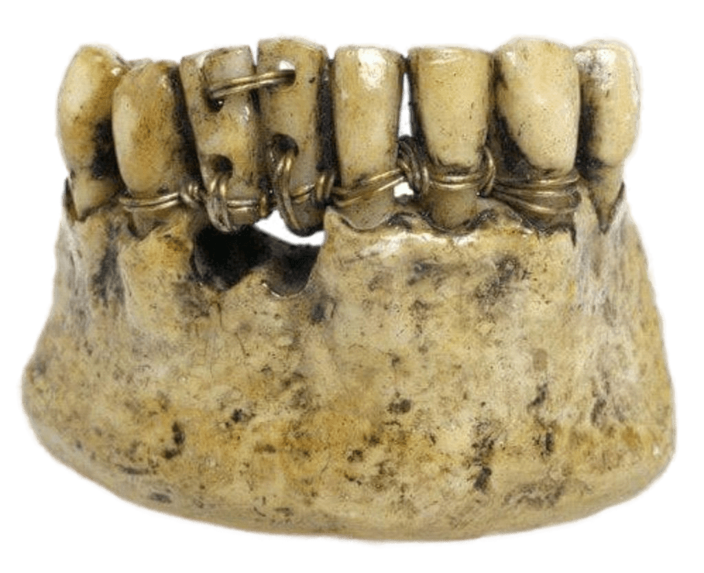 древние импланты