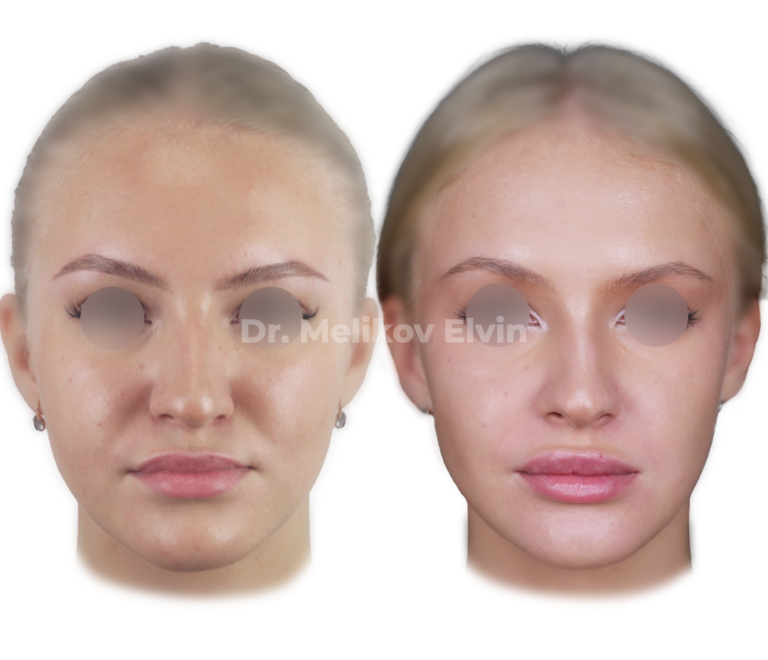 Фотографии до и после ортогнатической операции.