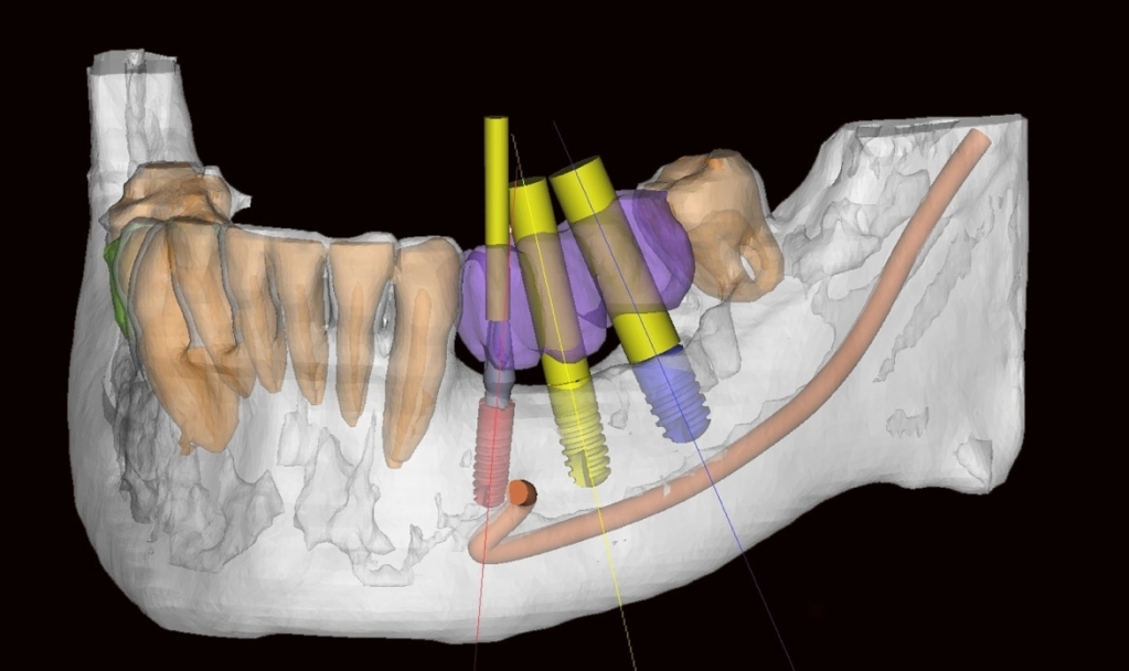 План имплантации. Планирование имплантации по кт. Планирование дентальной имплантации.