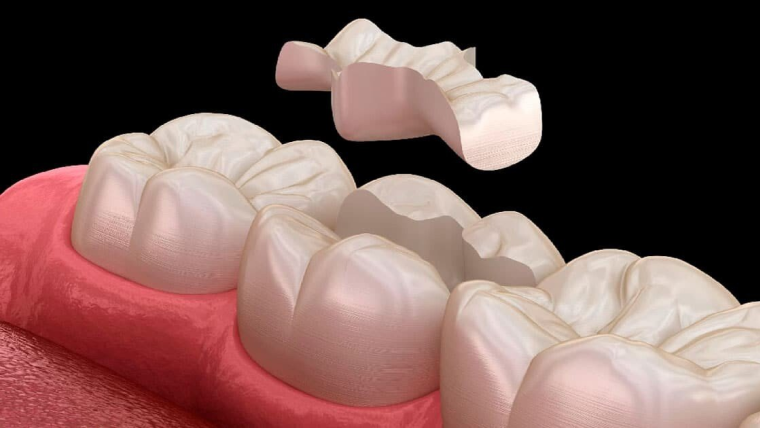 Зубные вкладки — виды и цены в Дербенте. Стоматология DK 