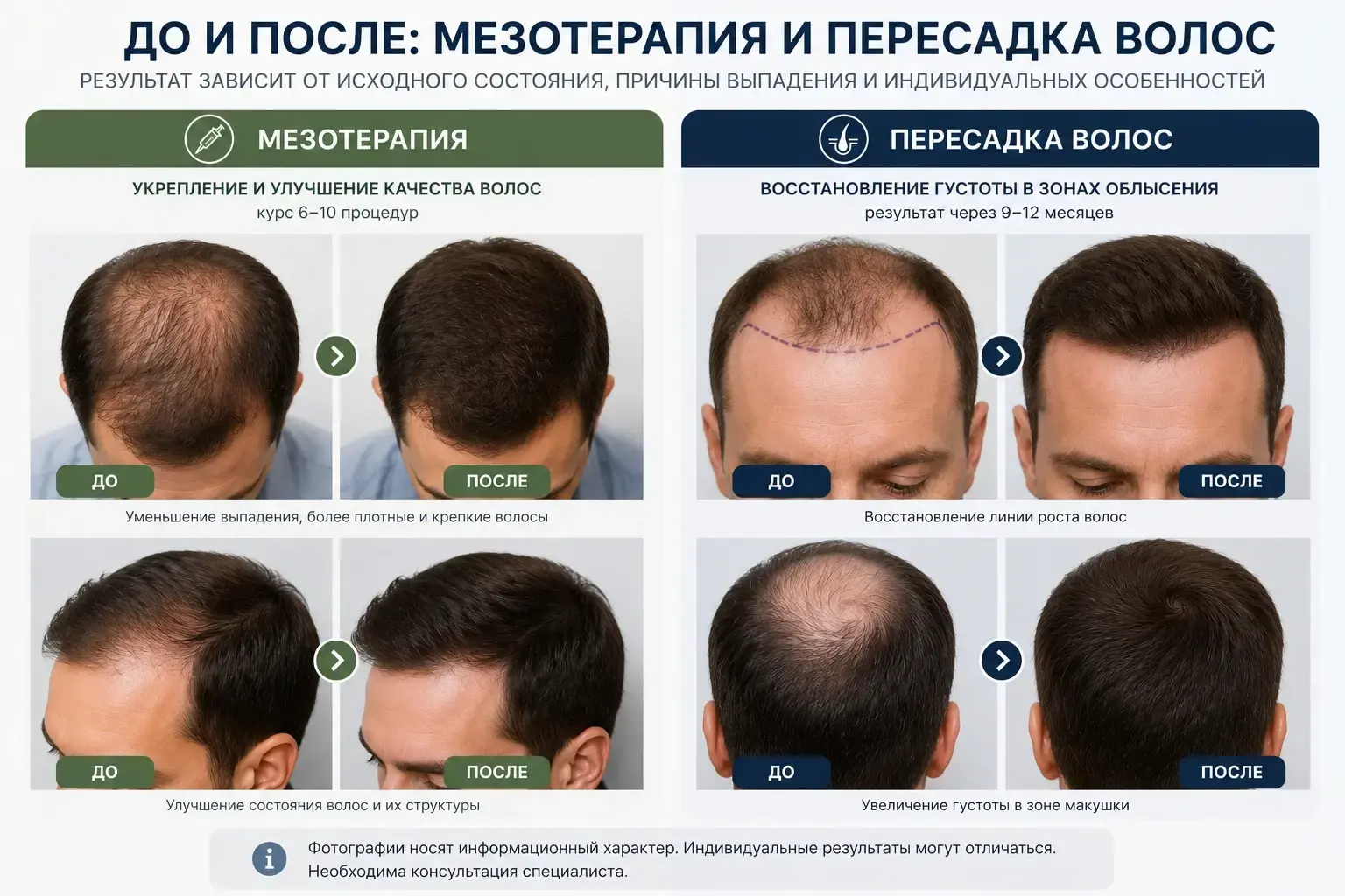 мезотерапия и пересадка волос: до и после