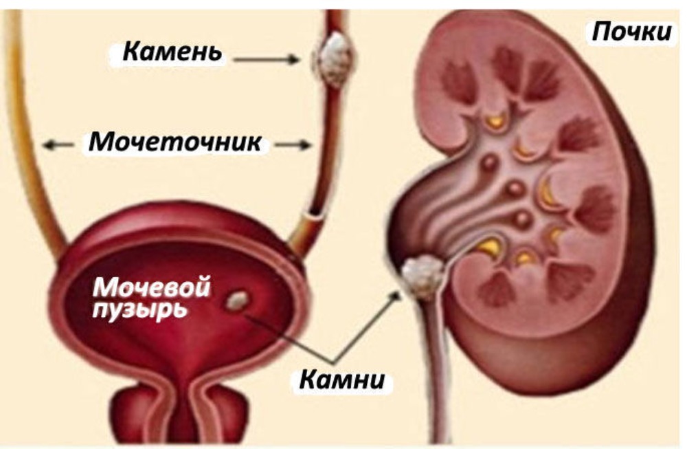 Камни в почках у мужчин симптомы лечение. Мочекаменная болезнь мочевого пузыря. Мочекаменная болезнь мочеточника. Камни в почках мочеточнике и мочевом пузыре. Почки мочеточники мочевой пузырь.