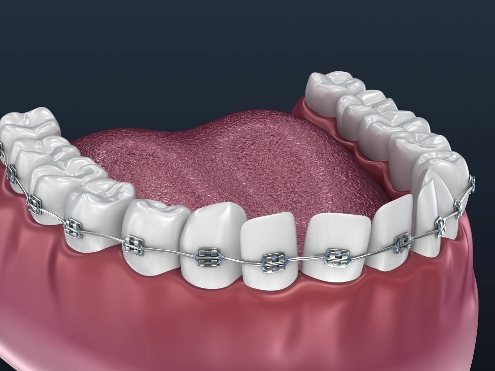 Ortho. Брекеты 3d модель. Модели с брекетами. Брекеты макет.