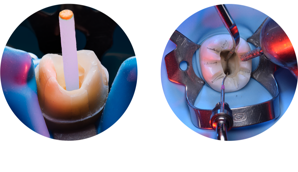 Postendodontic rehabilitation buildup, post, overlay, crown