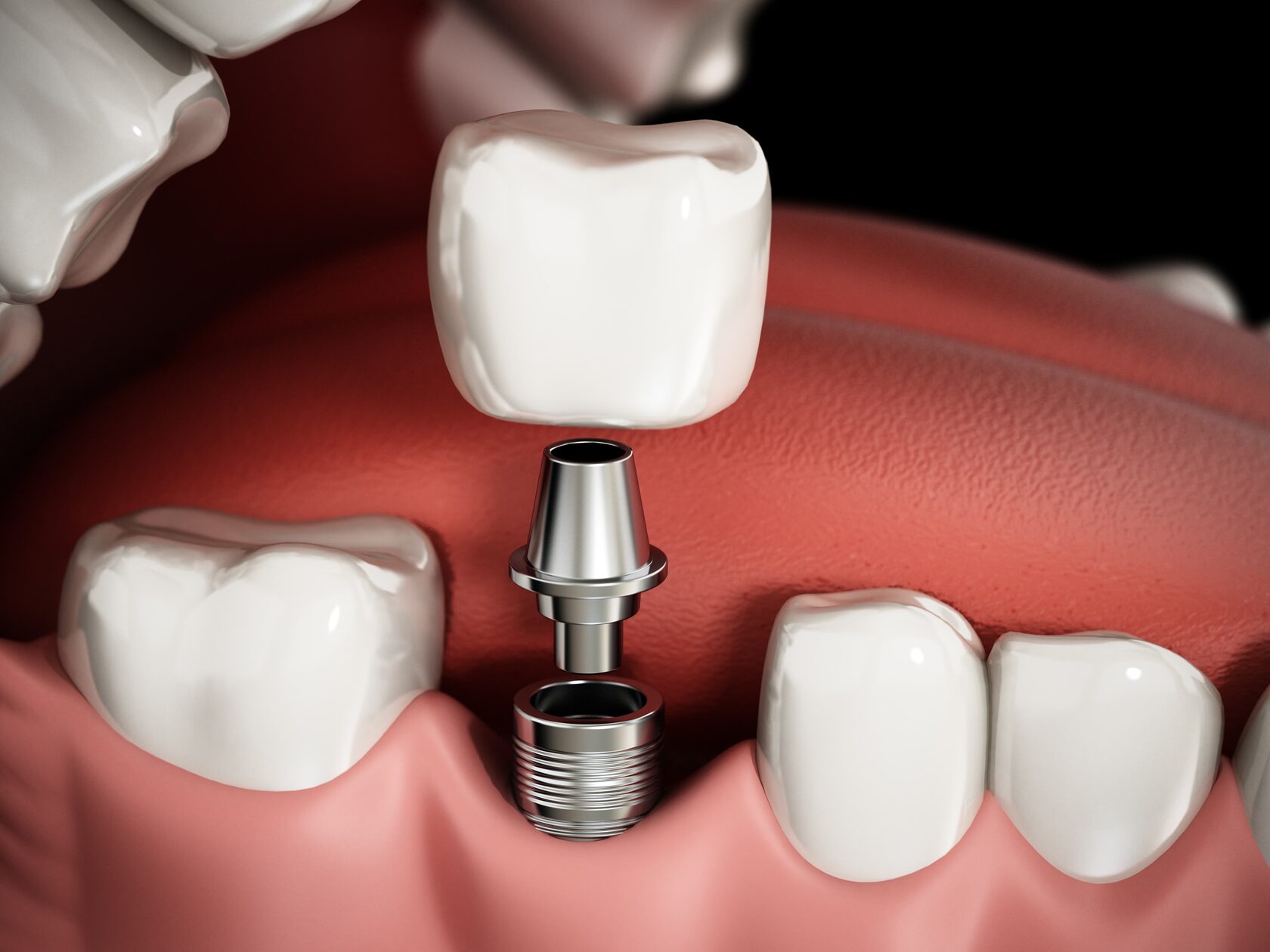 Имплантация зубов при заболевании, известном как Цинга