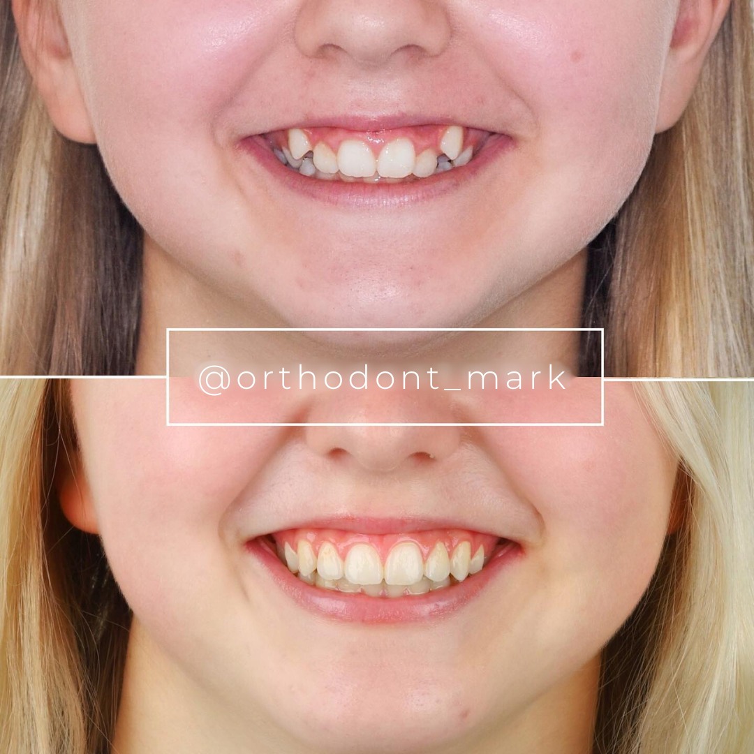 Correcting Crowding and Canine Overlap Without Veneers