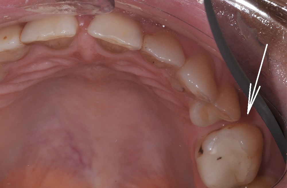 Подготовка места для импланта через устранение смещения зубов с помощью брекетов на минивинтах