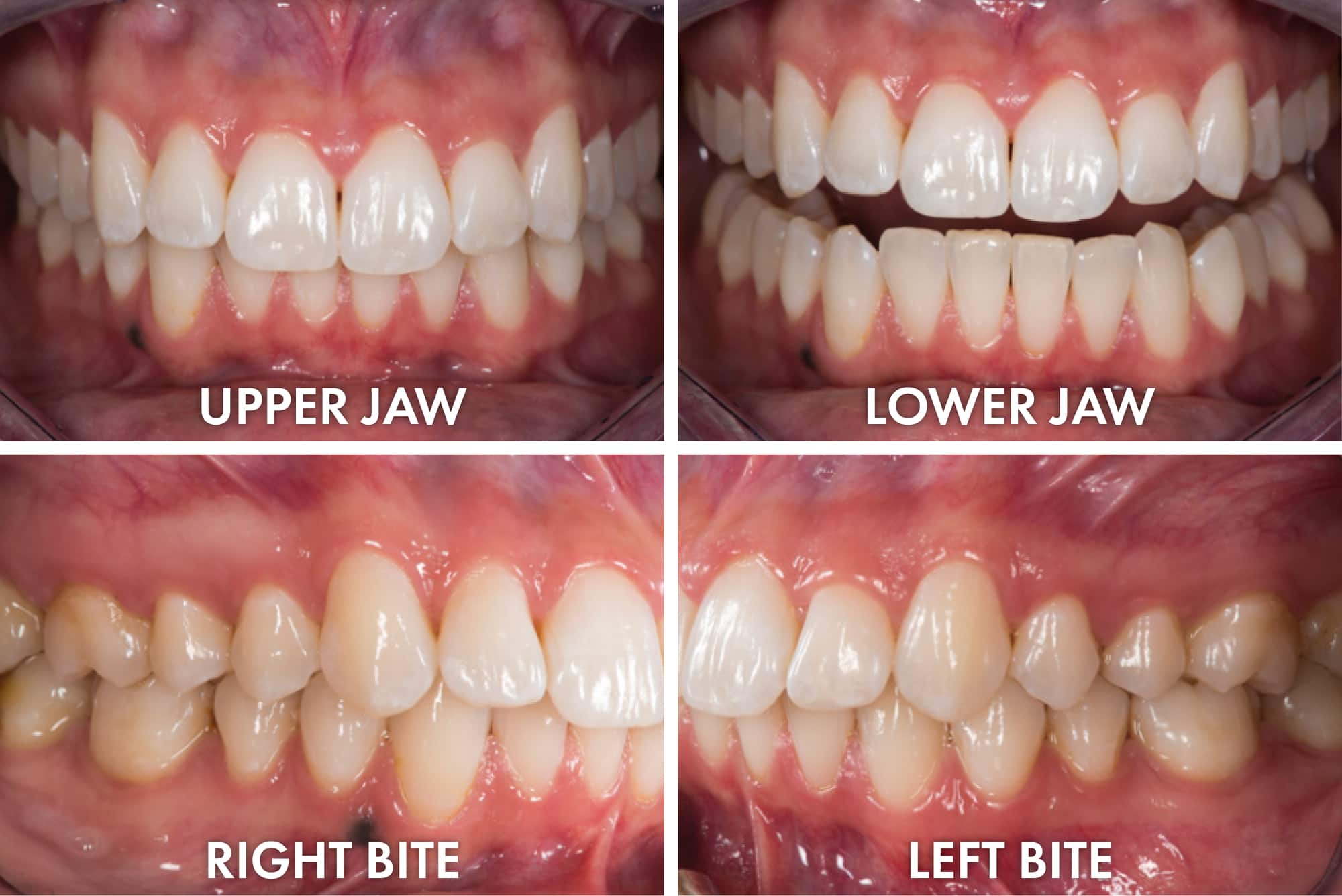 Order individual removable veneers RUVENEERS