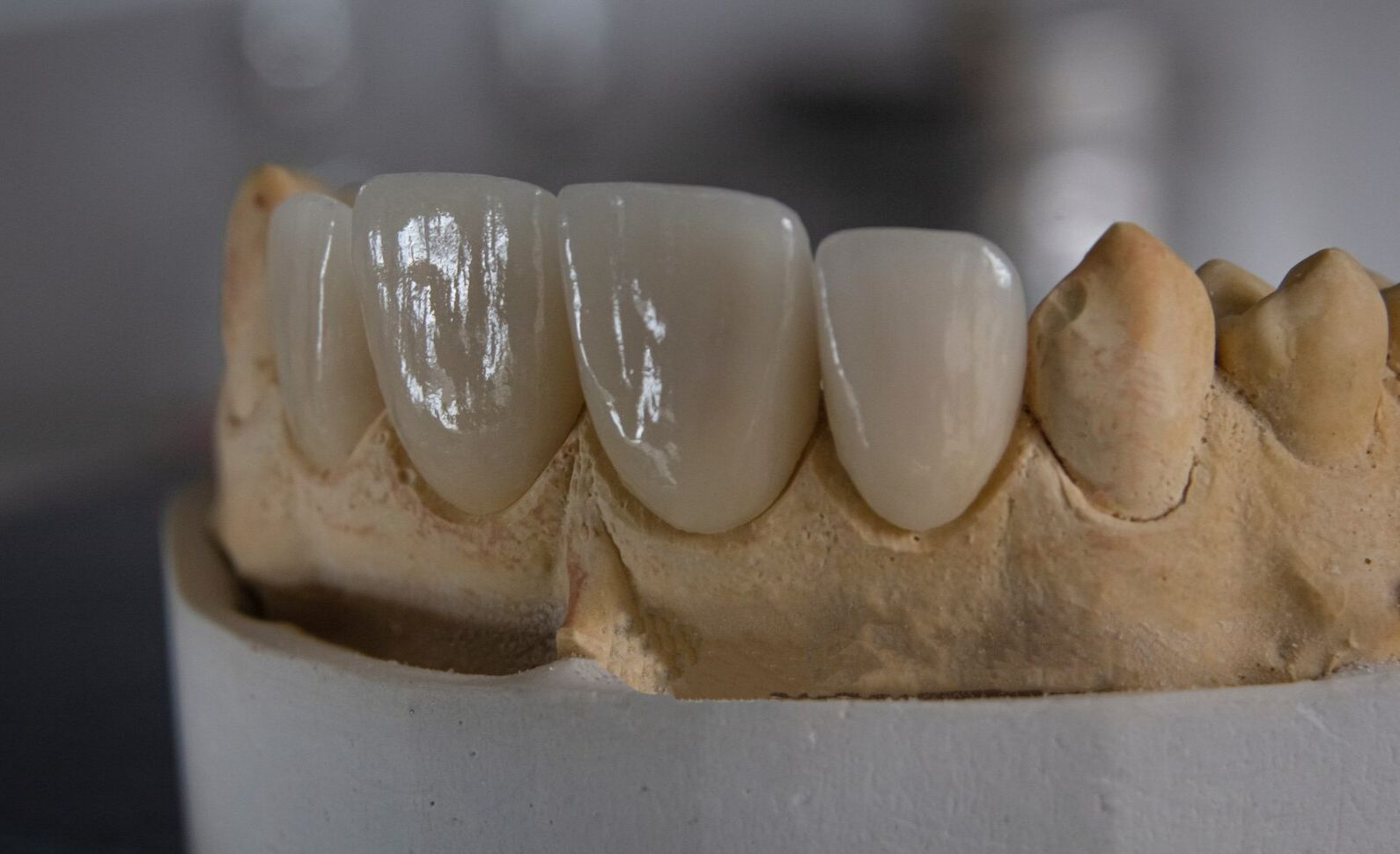 красивые зубы из металлокерамики фото